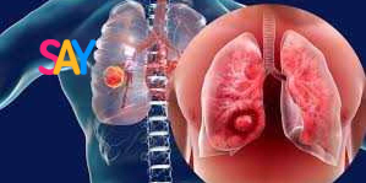 8 Surprising Signs Of Lung Cancer