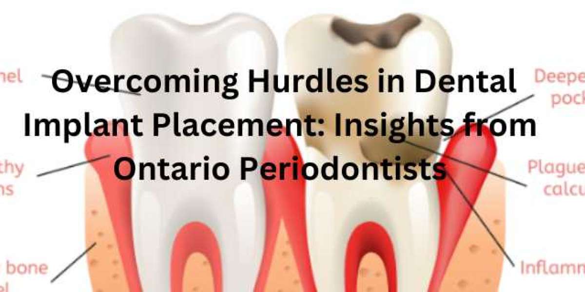 Overcoming Hurdles in Dental Implant Placement: Insights from Ontario Periodontists