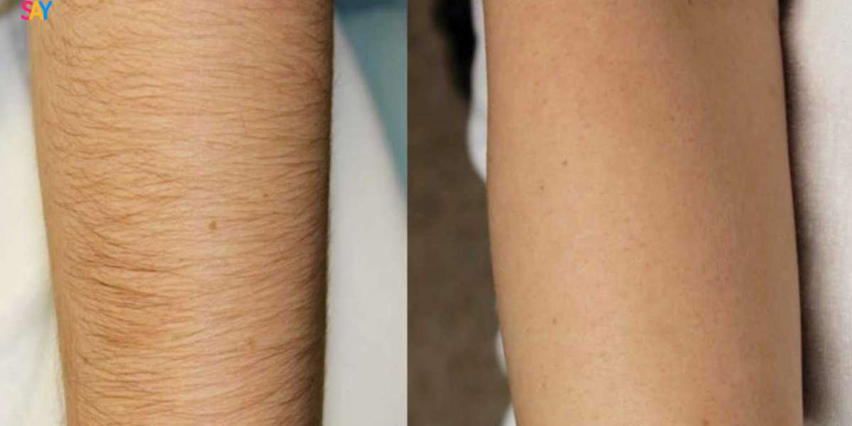 Average Laser of Hair Removal Cost
