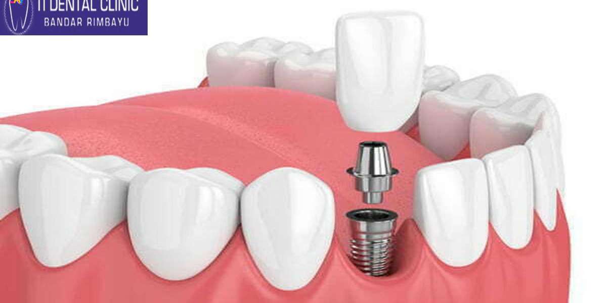 Know About Dental Implants at Tidental