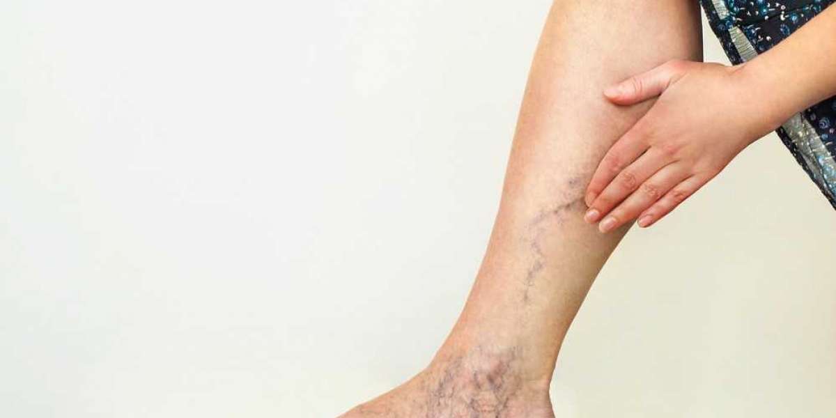 Causes of Varicose Veins in Legs Explained by The Best General Surgeon in Gurgaon