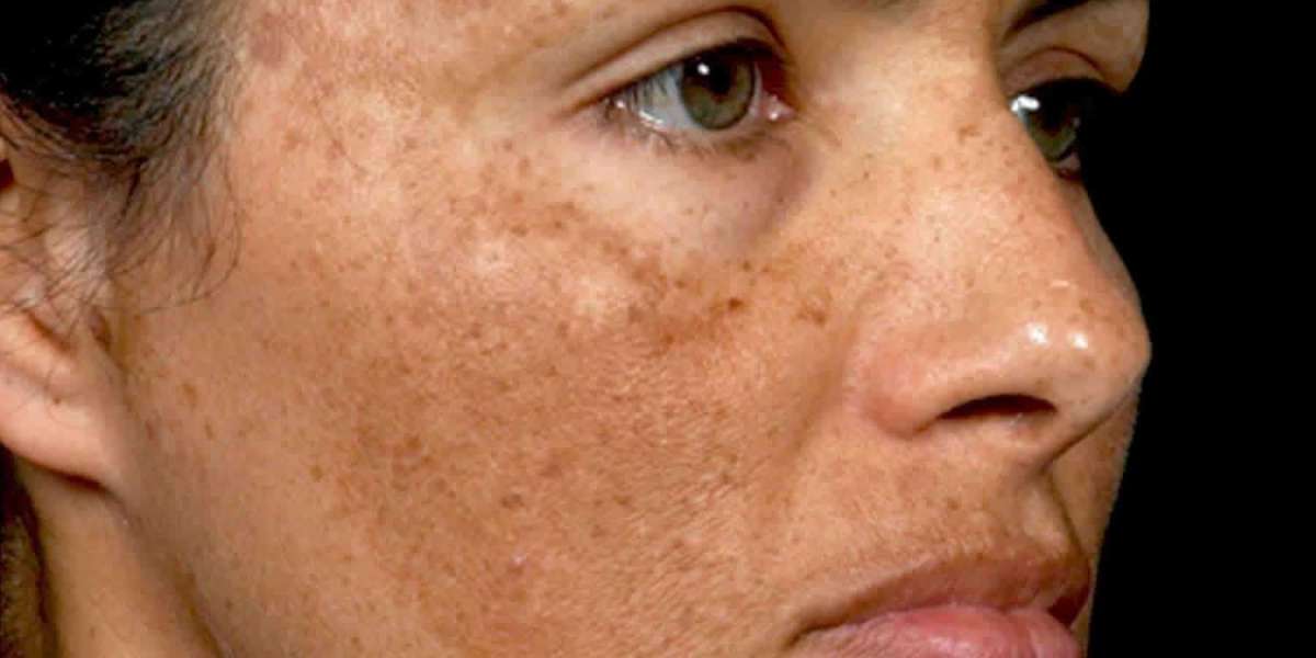 What is the Root Cause of Pigmentation?