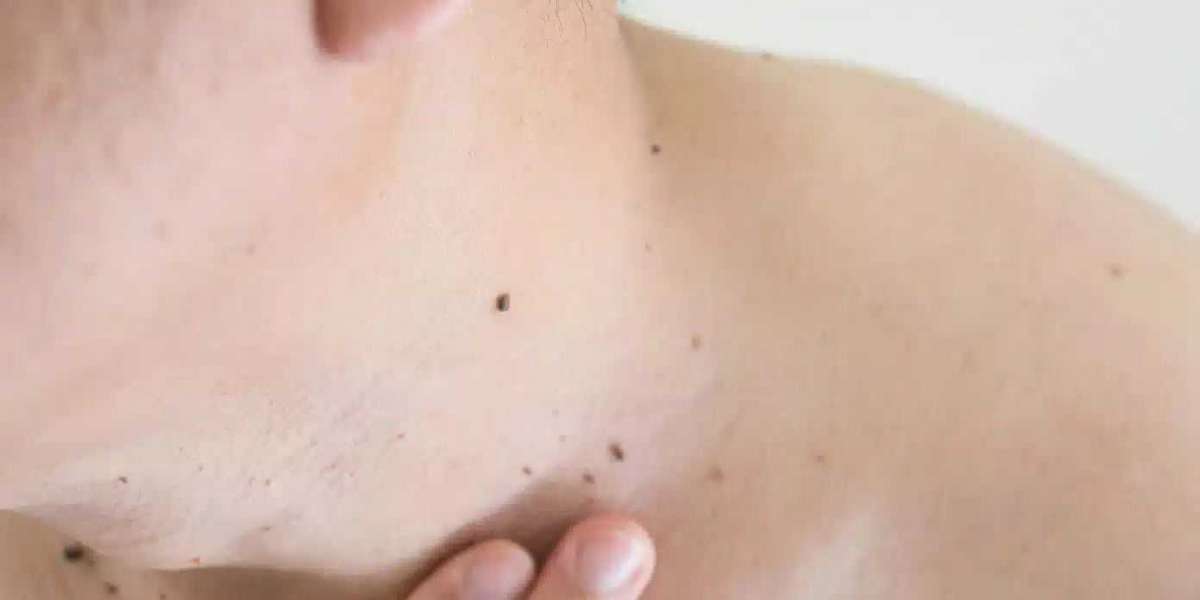 Discover How Salicylic Acid Helps Remove Warts and Skin Tags