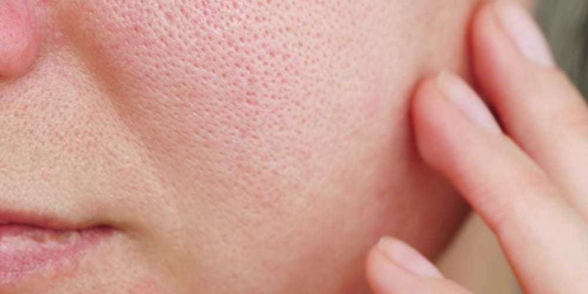 Top 10 Effective Treatments for Large Pores