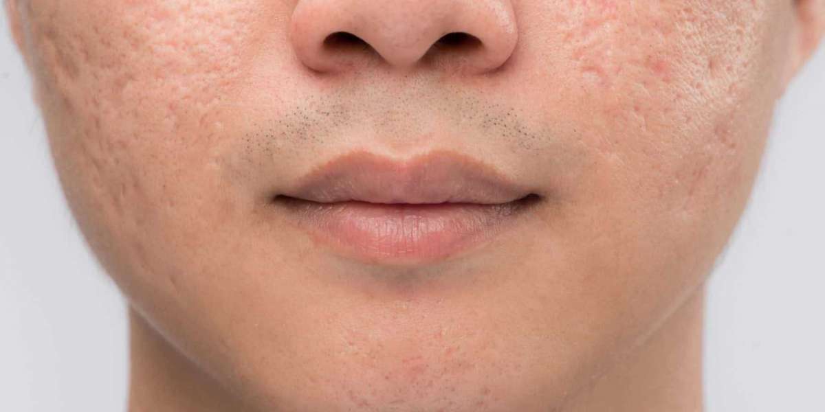 Acne Scar Treatment That’s Safe for Dark Skin