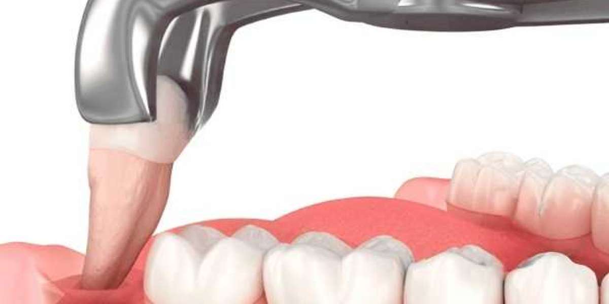 How Long Will It Bleed After Wisdom Tooth Extraction?