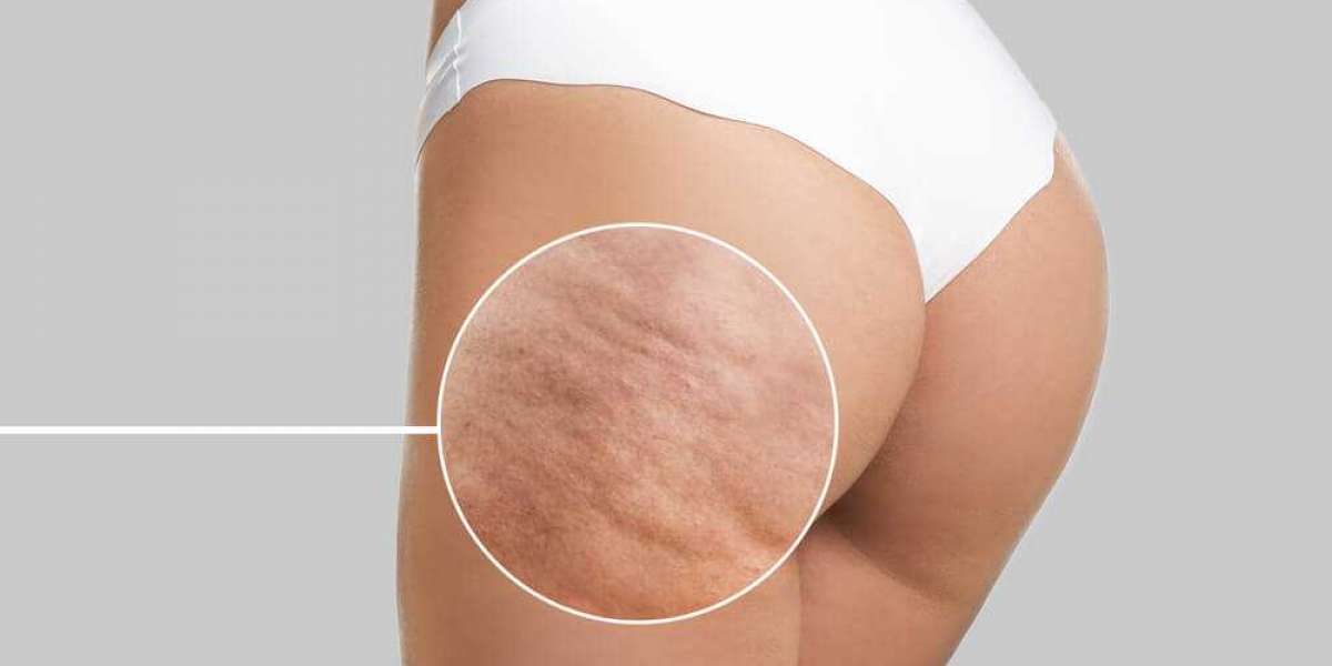Does cellulite go away when you get toned?