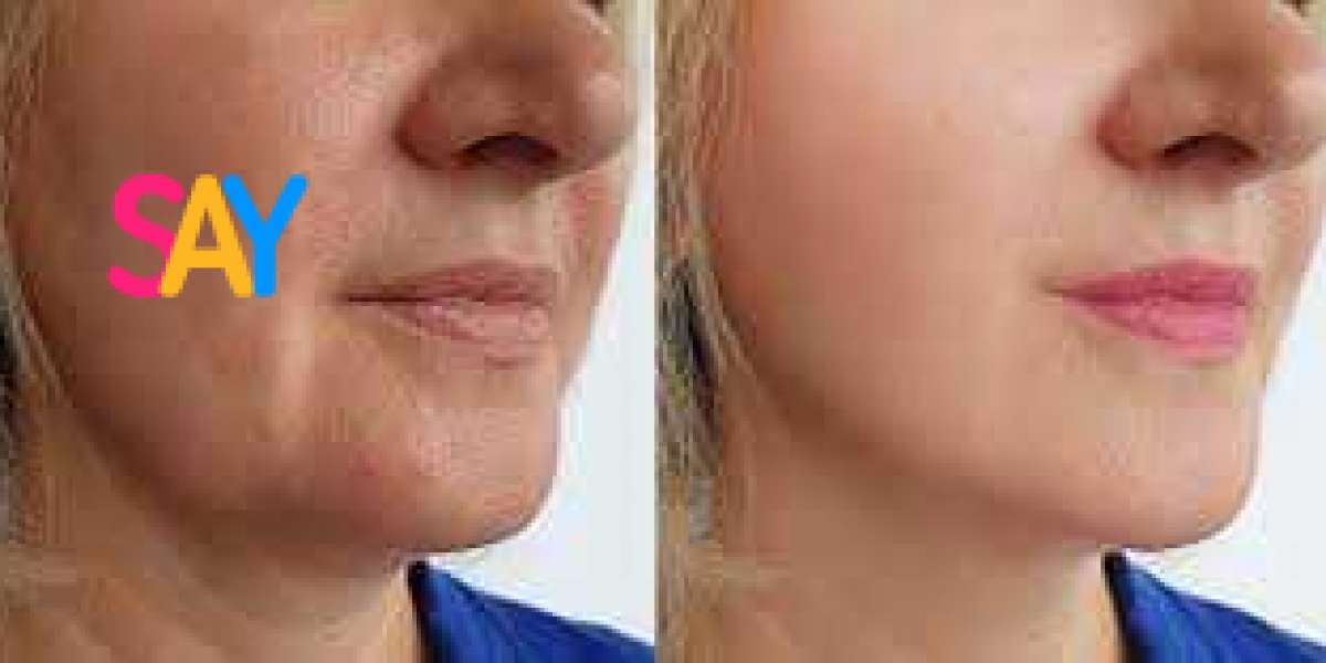 Skapa En Perfekt Ansiktsprofil med Fillers Haka i Stockholm