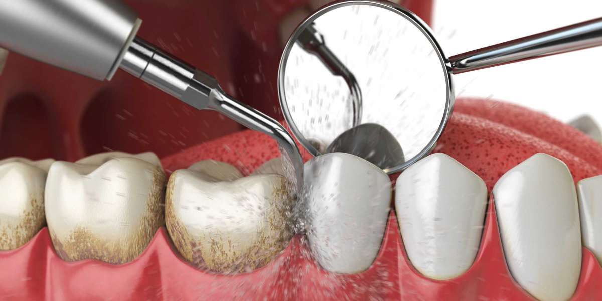 Can I eat rice after deep cleaning?