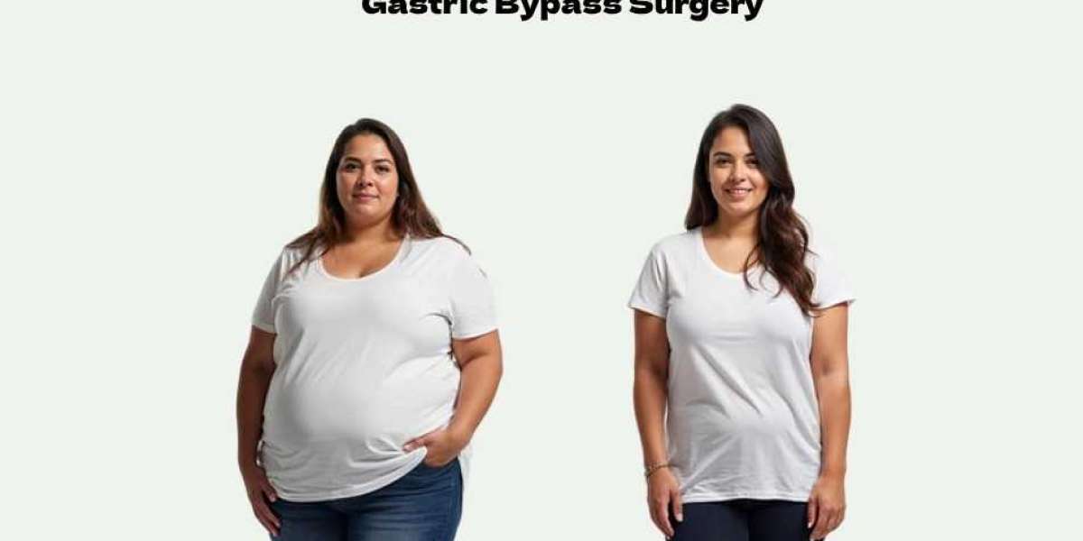 Roux En-Y Gastric Bypass Surgery: A New Beginning for Lasting Weight Loss