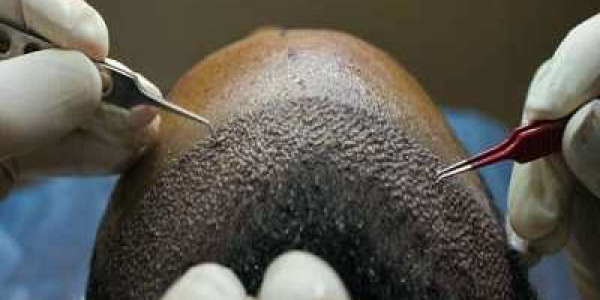 Comparing Hair Transplant Techniques Available in Islamabad