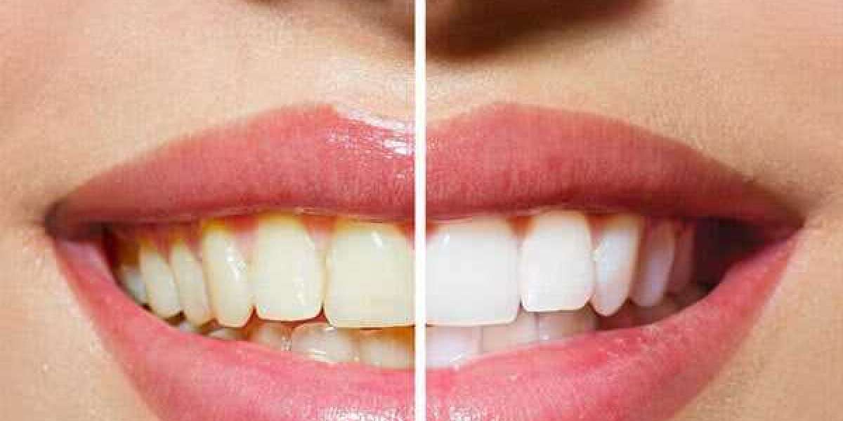 Is Laser Teeth Whitening Right for You?