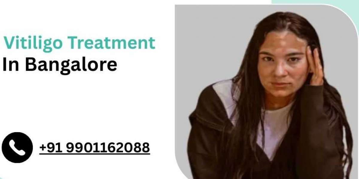 Vitiligo: Causes, Types, Treatment and Recovery