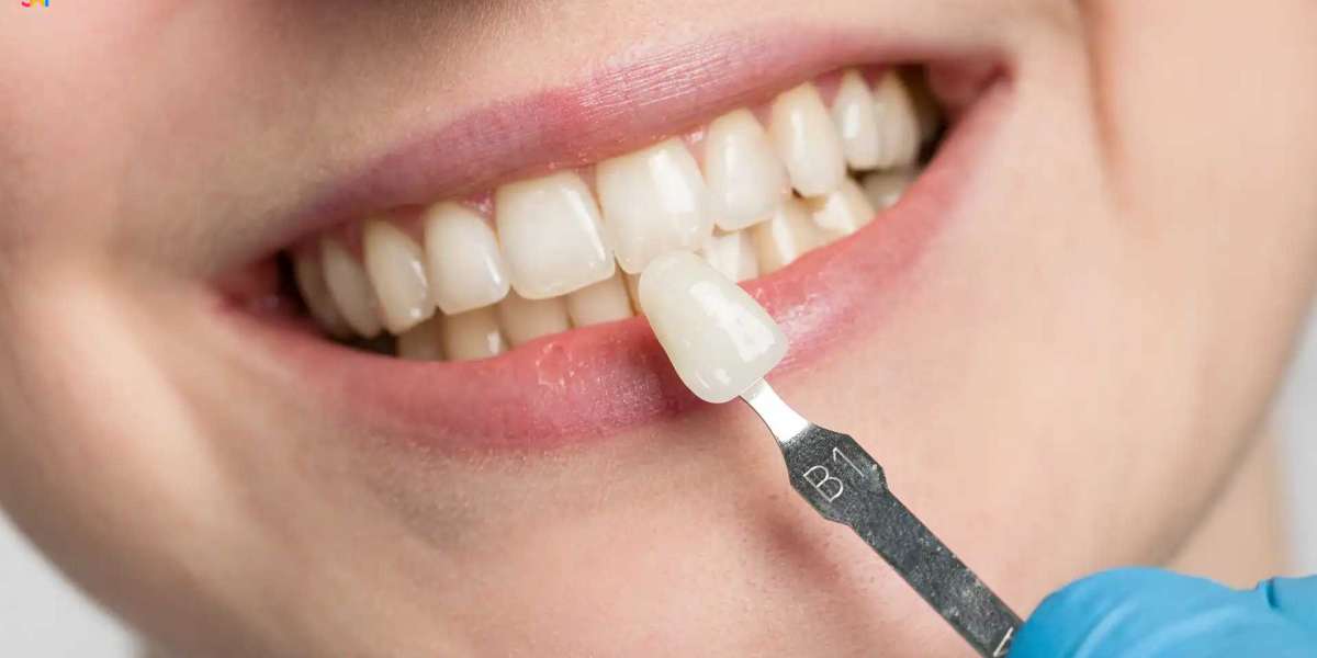What to Know Before Getting Composite Veneers?