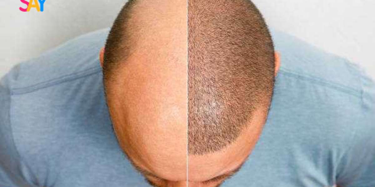How Hair Loss Treatment Can Restore Your Confidence
