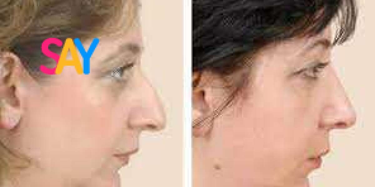 Can I Still Wear Glasses After My Rhinoplasty in Dubai?