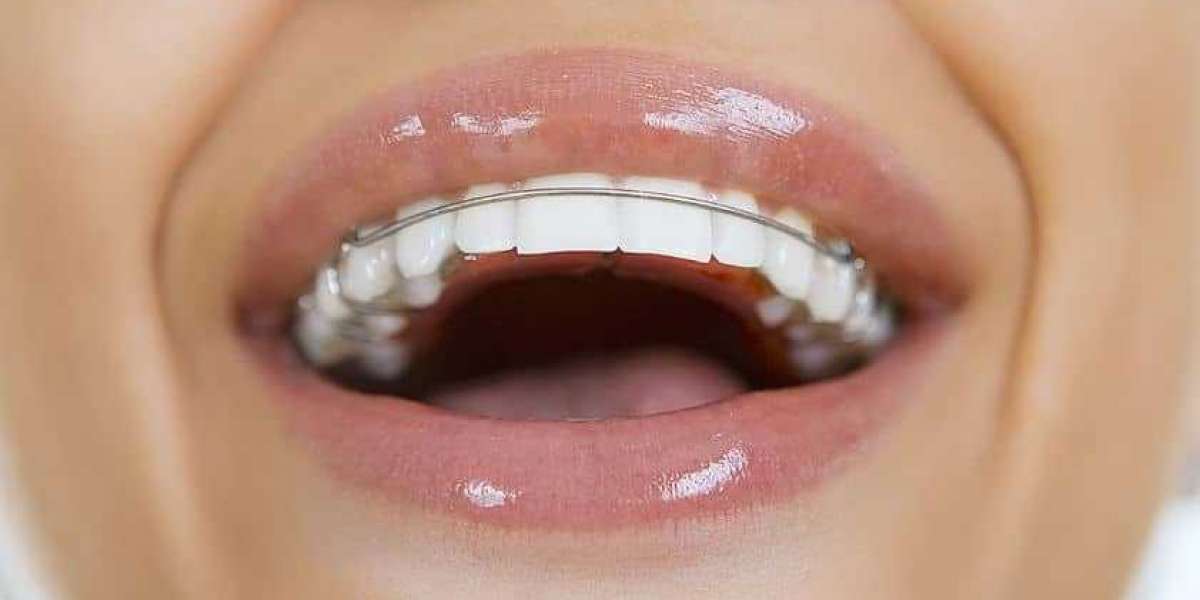 Are Retainers Covered Under Orthodontic Treatment?