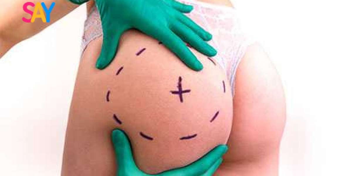How Soon Can I Exercise After Buttock Augmentation?