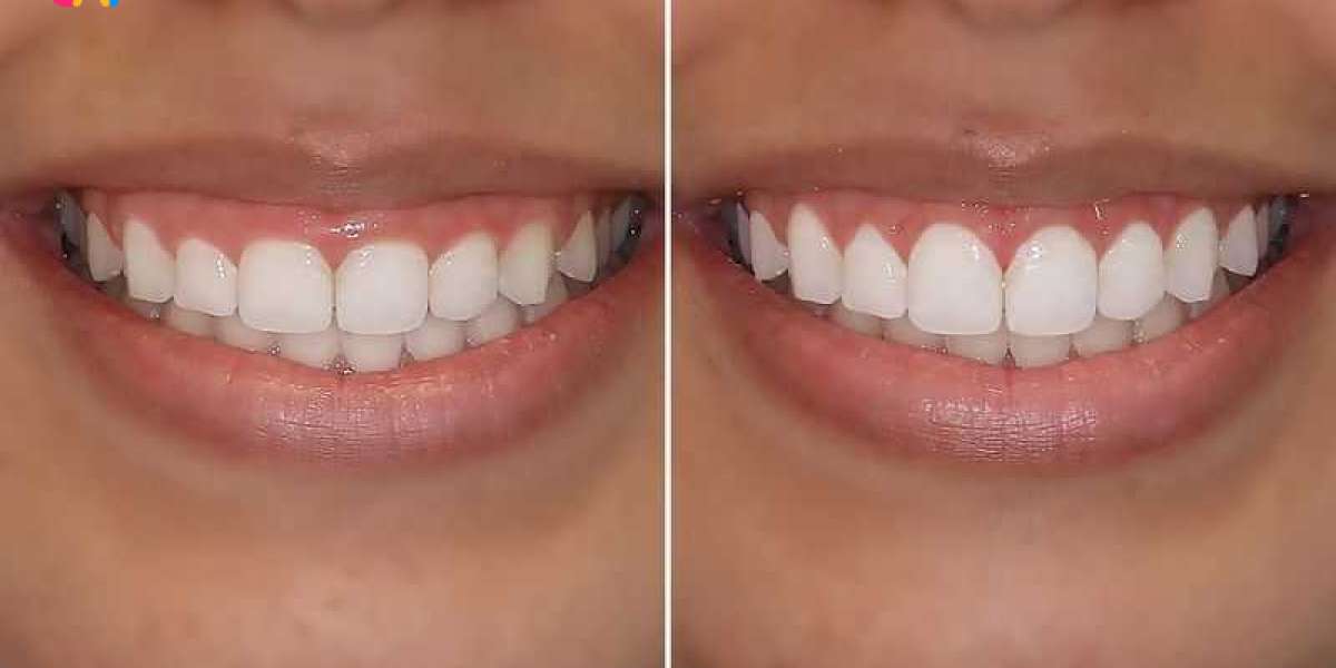 Gingivectomy for Better Crown Fit or Orthodontic Work