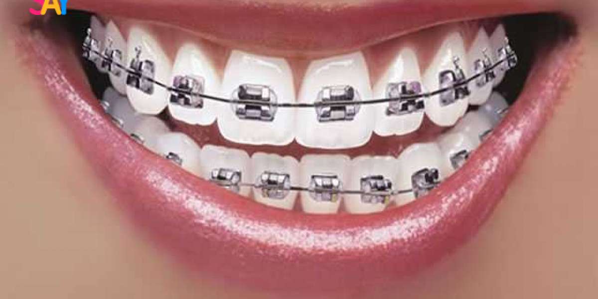 Do Braces Interfere with Kissing or Dating?