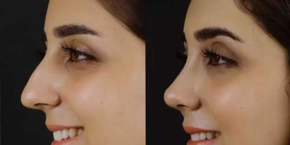 How Septoplasty in Dubai Can Improve Your Sleep and Life
