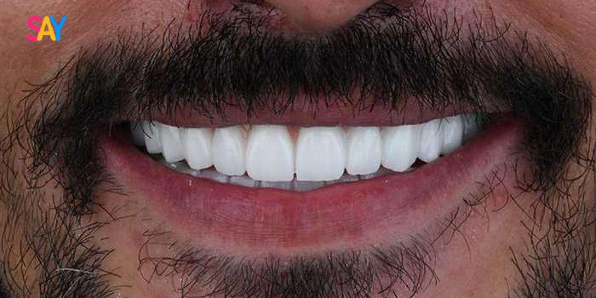 Is There a Risk of Gum Irritation from Veneers in Dubai?