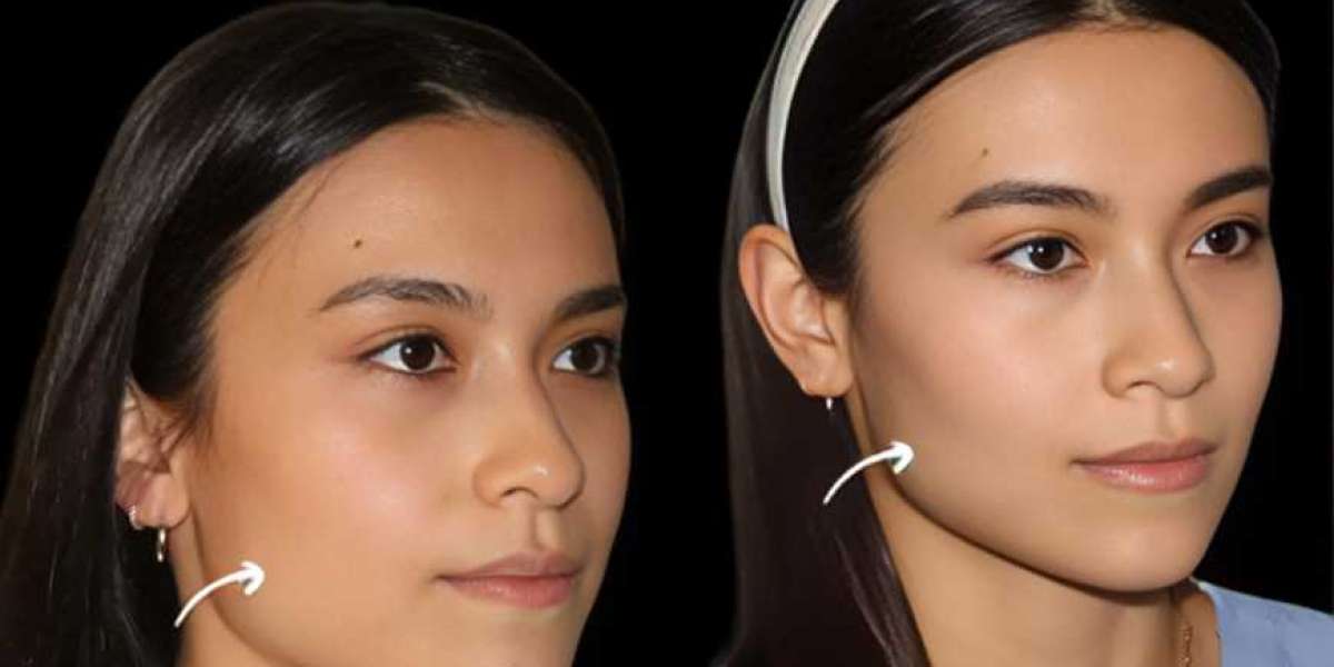 Best Doctors in Dubai on Ethical Use of Sculptra Fillers