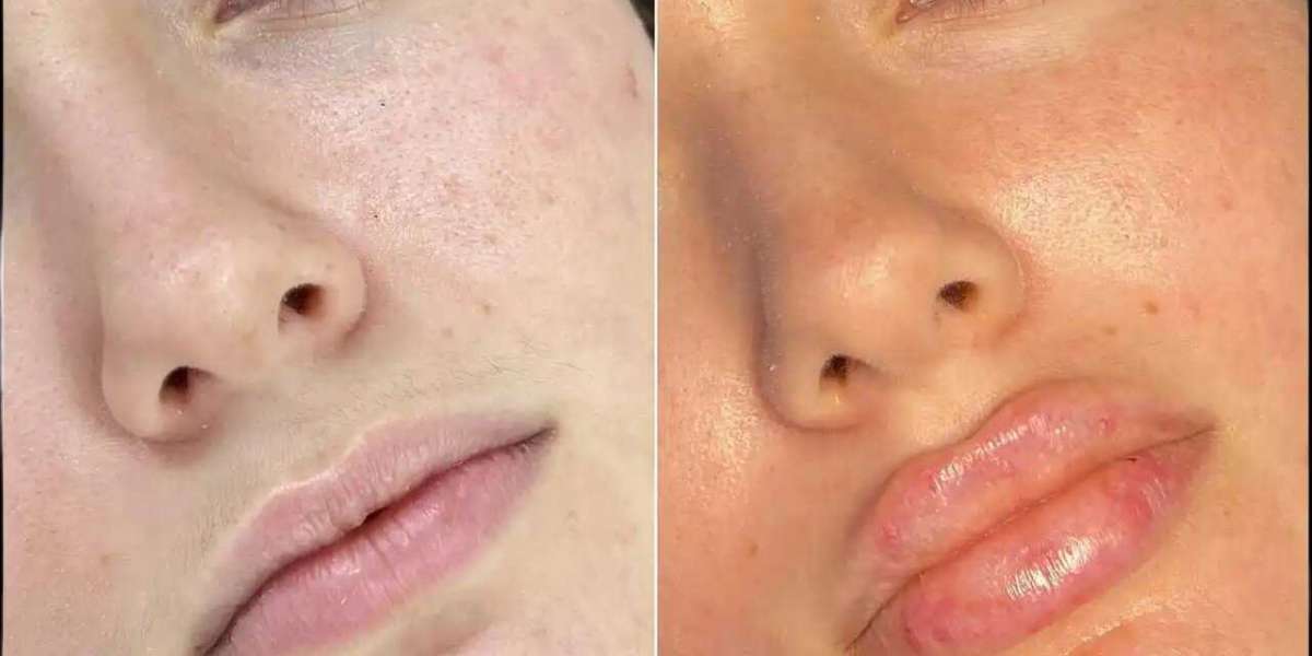 Best Doctors in dubai for Fillers: A Popular Choice for Wrinkle-Free Skin