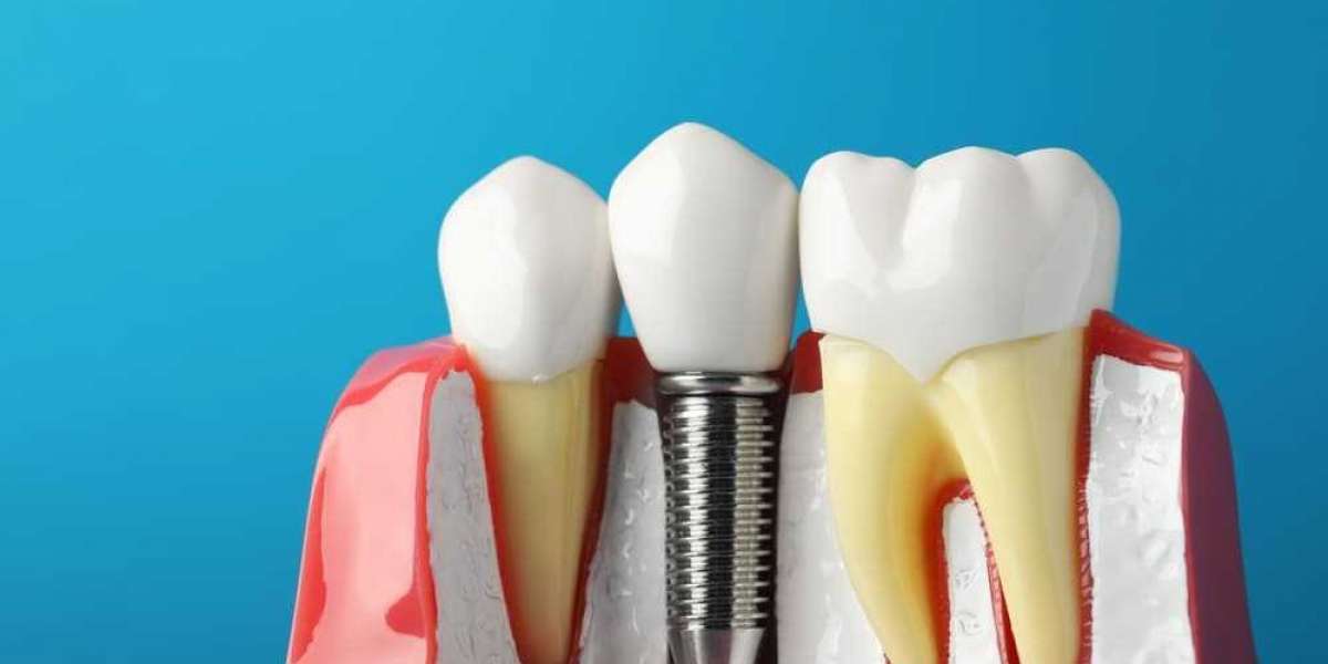 What Is the Success Rate of Dental Implants in Dubai?