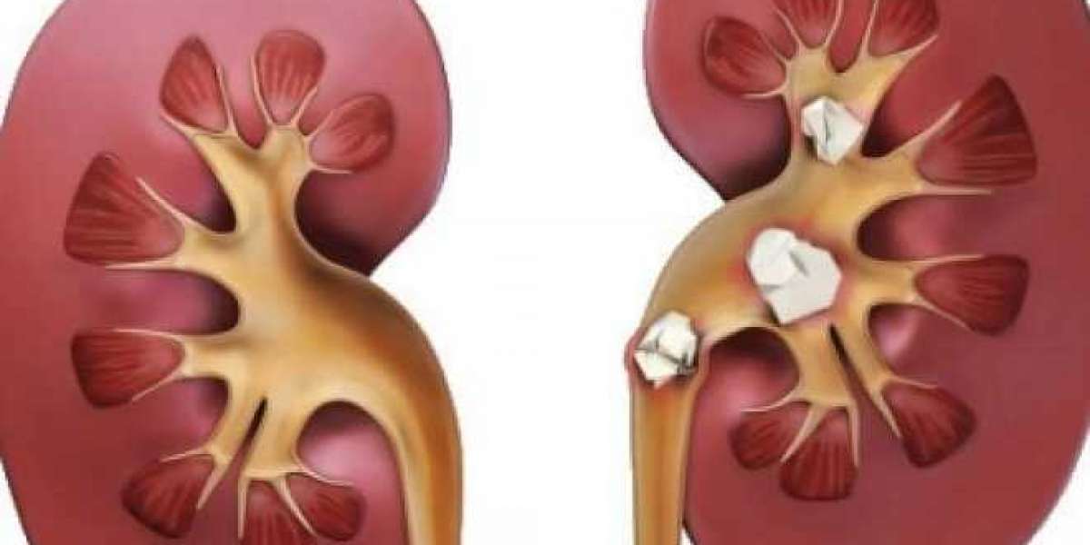 Exploring Ayurvedic Treatment For Kidney Stone: Ancient Solutions for Pain-Free Living
