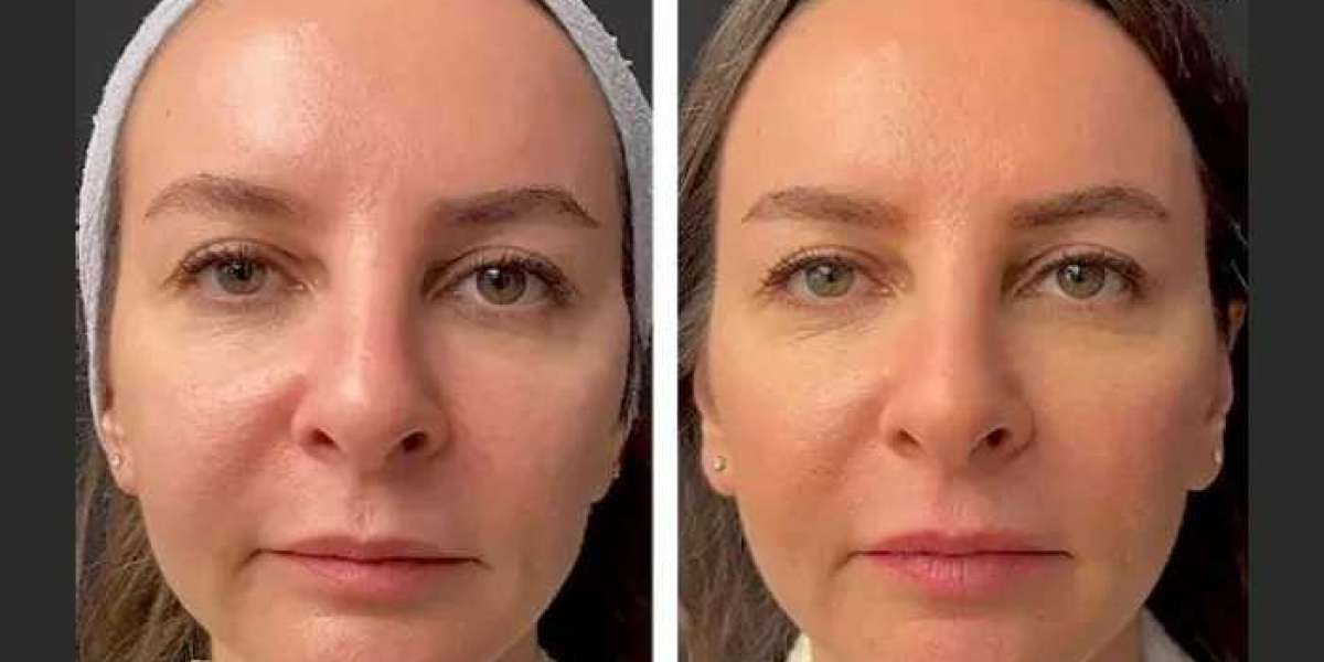 Mesotherapy for Anti-Aging at the Best Aesthetic Clinic in Dubai